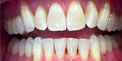 invisalign-after-1