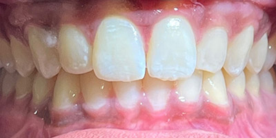 smile-invisalign-01-after