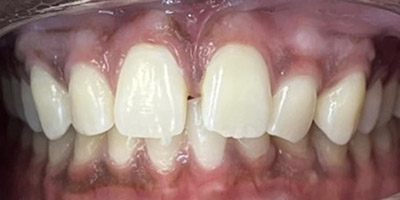 smile-invisalign-01-before