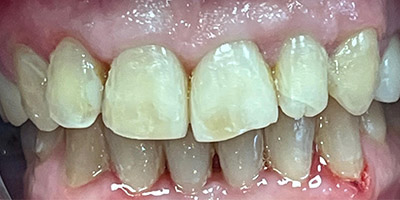 smile-invisalign-01-after