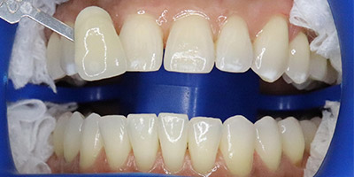 smile-zoom-01-before