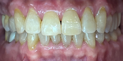 invisalign-1-after