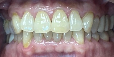 invisalign-1-before