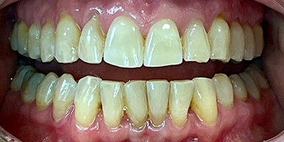 invisalign-2-after