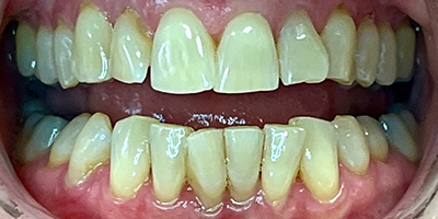 invisalign-2-before