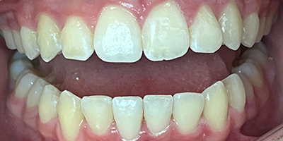 invisalign-3-after