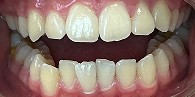 invisalign-3-before