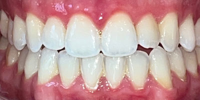 invisalign-new-after