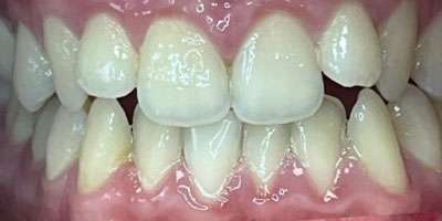 invisalign-new-before